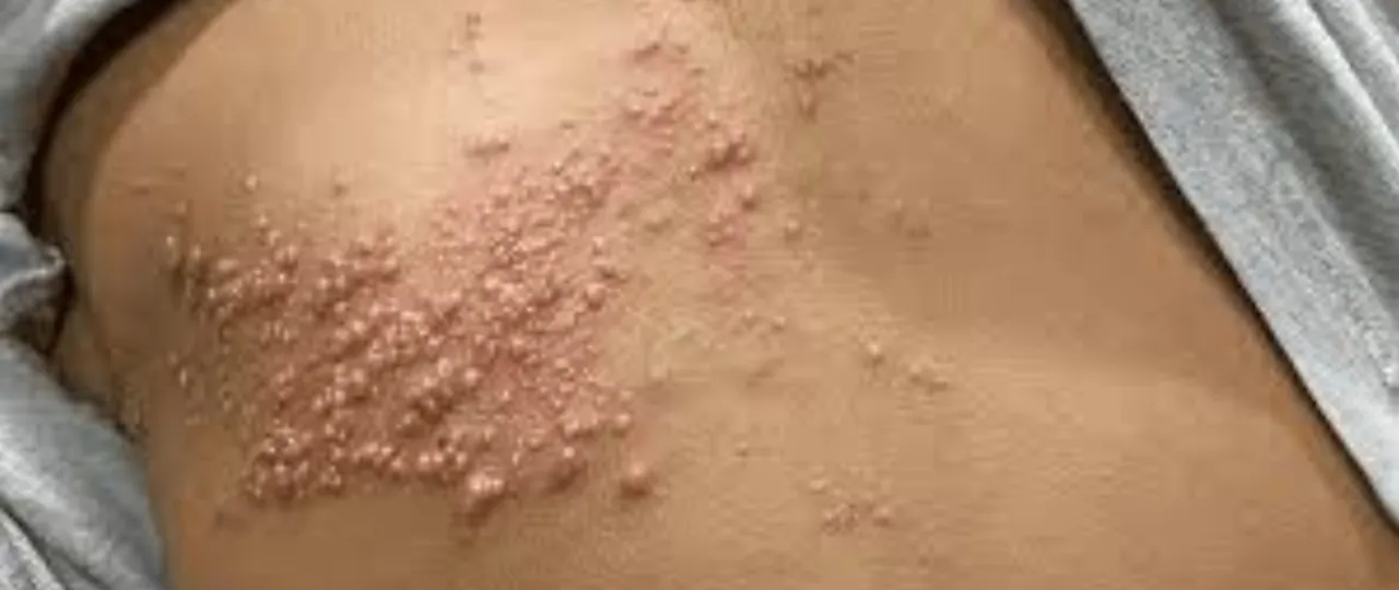 Półpasiec u osoby starszej lub z obniżoną odpornością