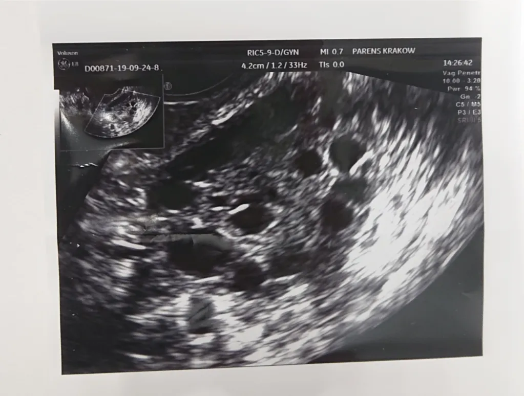 badania hormonalne u kobiet PCOS niepłodność