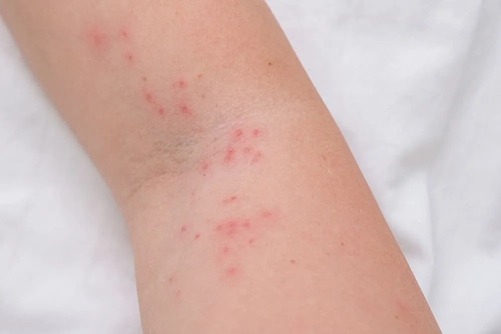 Alergia skórna u dziecka zmiany na policzkach zgięciach łokci