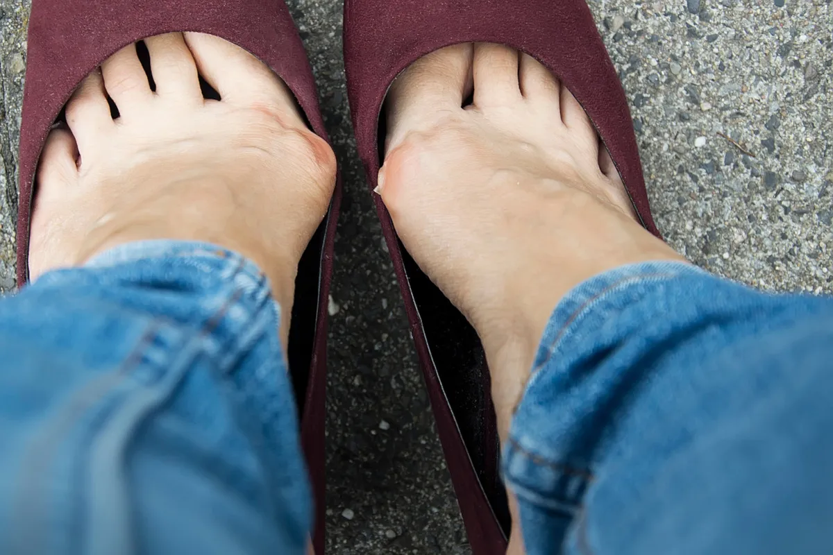 ćwiczenia na haluksy obuwie ortopedyczne