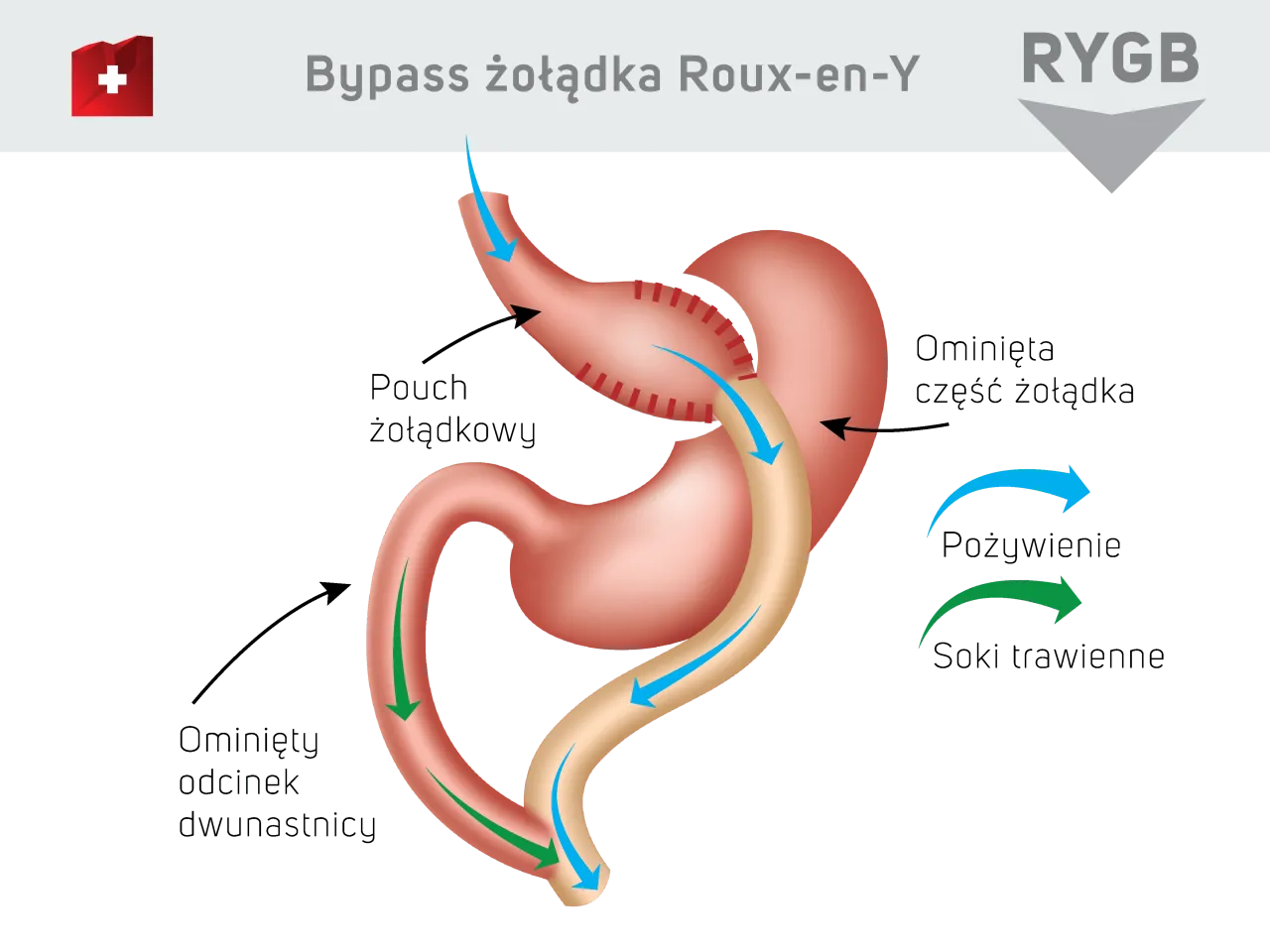 rekonstrukcja przewodu pokarmowego po gastrektomii Roux-en-Y schemat