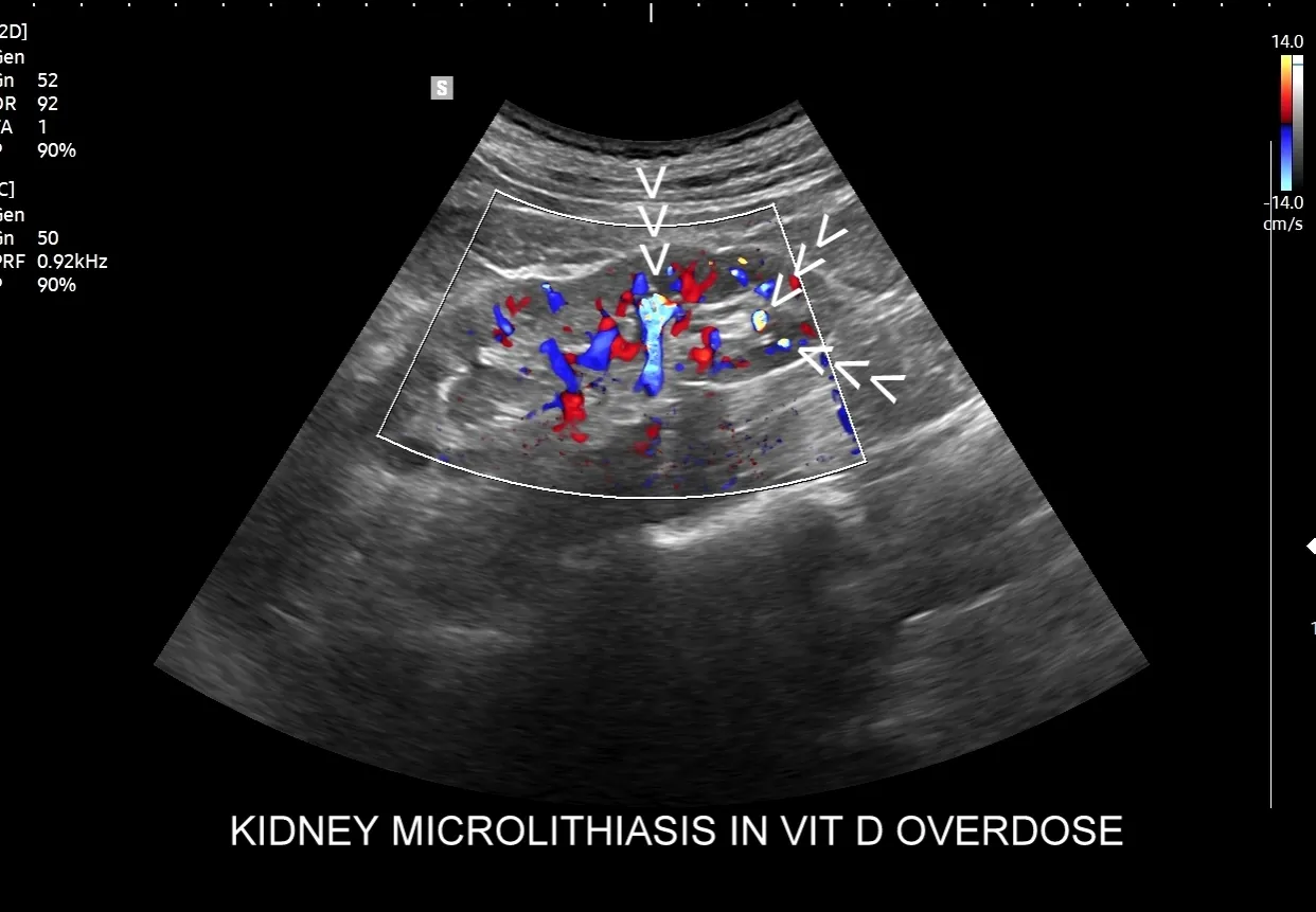 Diagnostyka kamicy nerkowej schemat