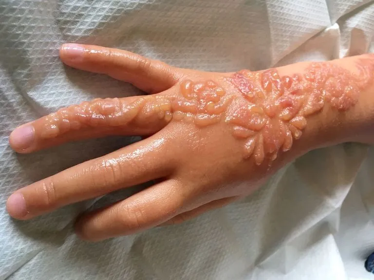 naturalna henna vs czarna henna r&oacute;żnice reakcje alergiczne
