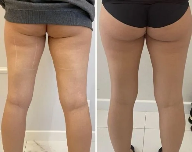 ćwiczenia na cellulit pośladki przed i po
