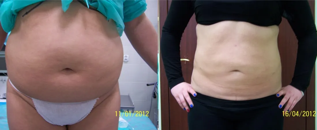 por&oacute;wnanie metod liposukcji brzucha grafika