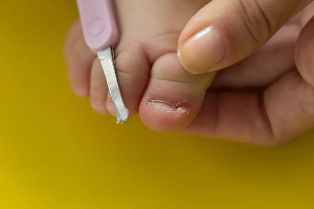 Zdjęcie Kiedy wrastający paznokieć wymaga wizyty u lekarza? Sprawdź specjalistów