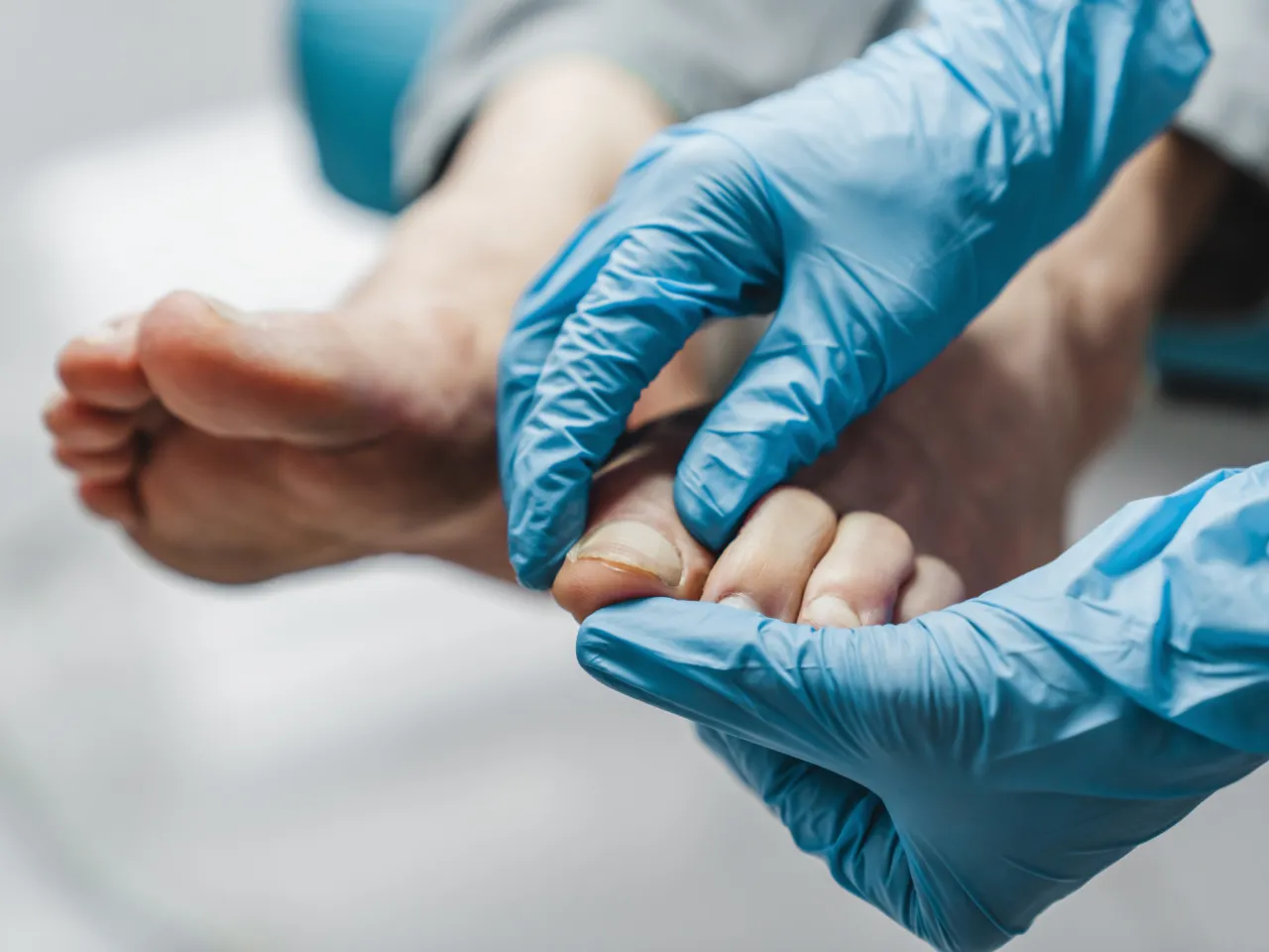 Przygotowanie do badania mykologicznego paznokci