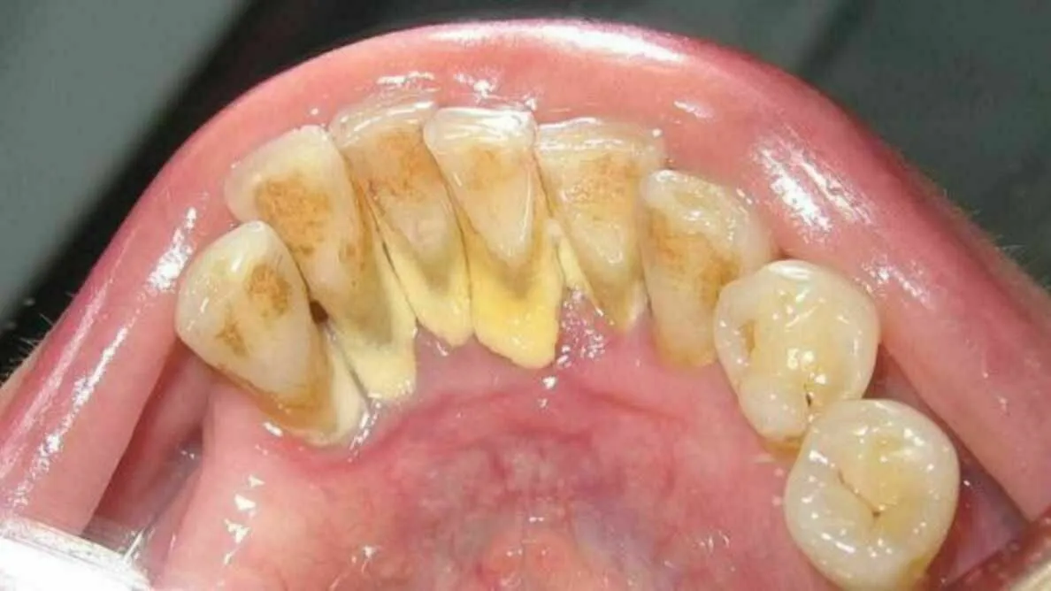 płytka nazębna kamień nazębny zęby