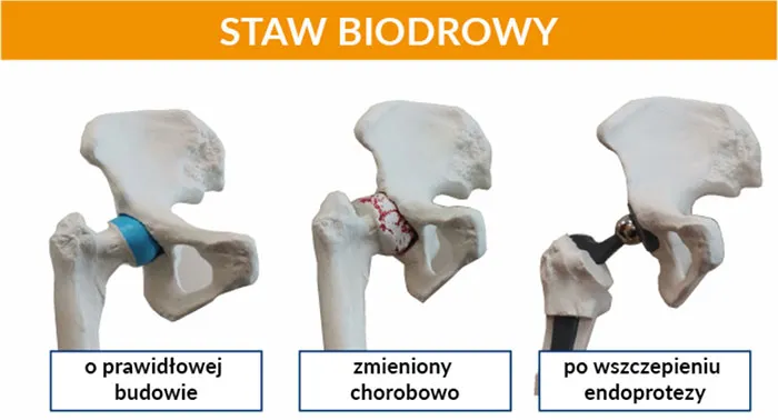 Zdjęcie Endoproteza stawu biodrowego NFZ gdzie najlepiej? Szybkie terminy i jakość