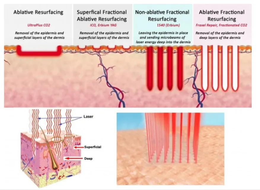 laser frakcyjny nieablacyjny schemat działania