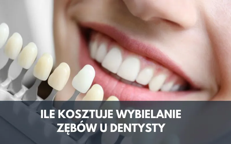 cennik wybielania zębów u dentysty