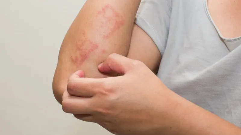 Objawy alergii na marihuanę oddechowe