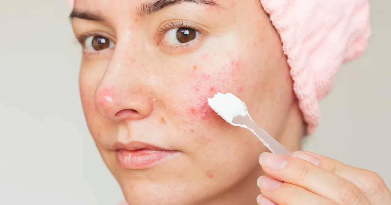preparaty apteczne na trądzik