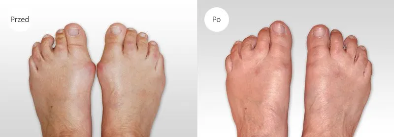 stopa z haluksem i stopa po operacji porównanie