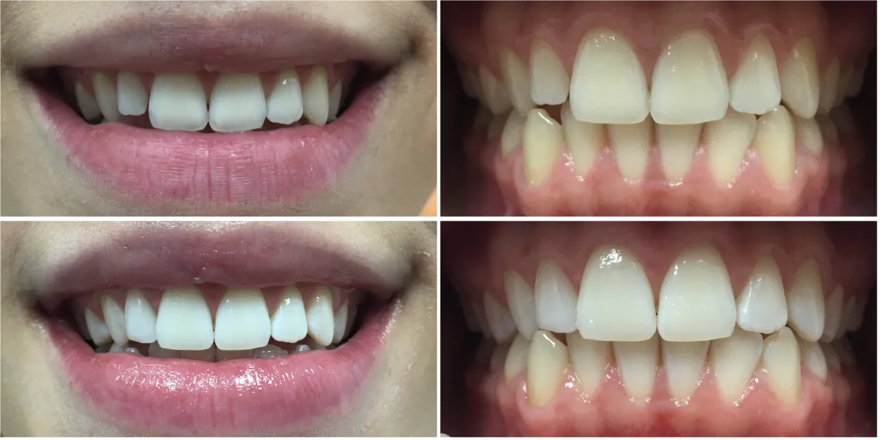 Zabiegi stomatologiczne odbudowa zębów