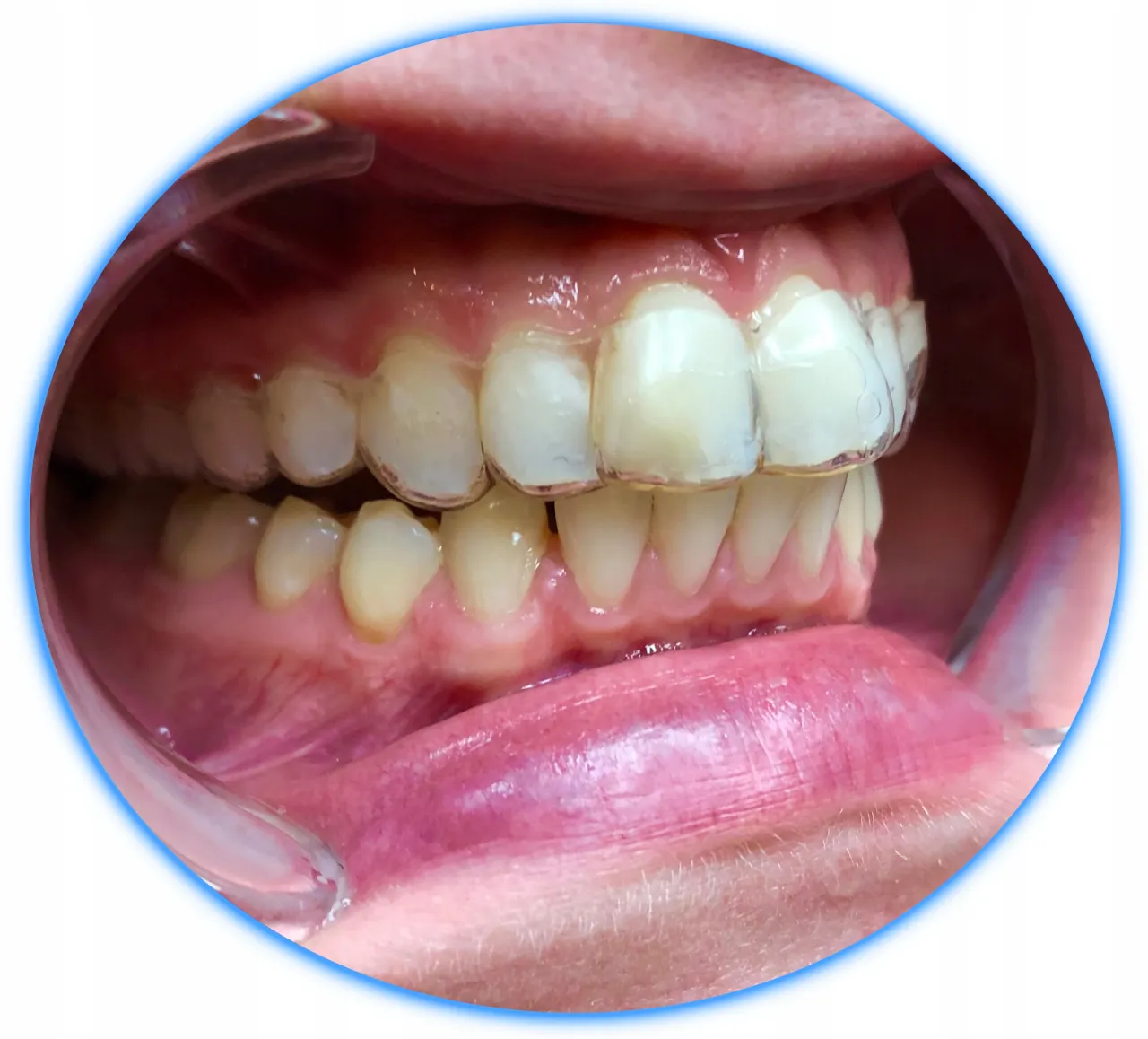 przezroczysta szyna retencyjna na zęby