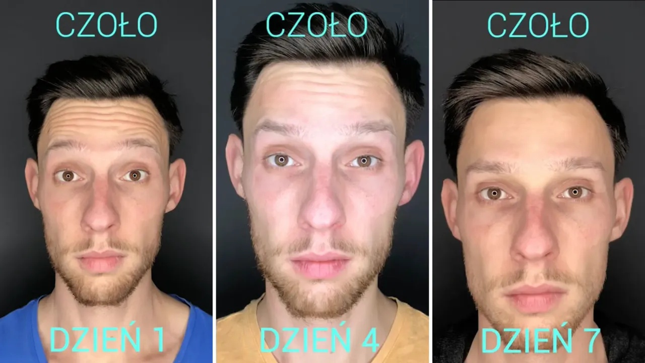 botoks czoło przed po efekty