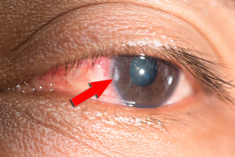 ciało obce w oku rodzaje