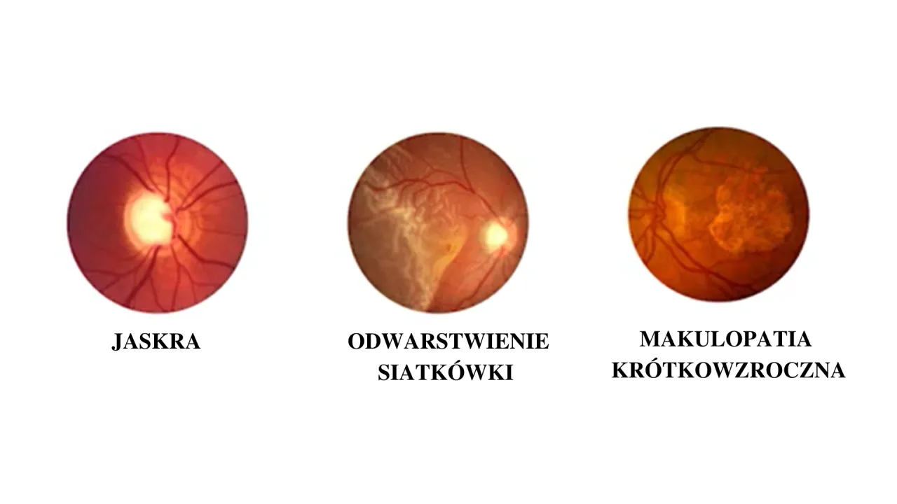 powikłania wysokiej kr&oacute;tkowzroczności siatk&oacute;wka