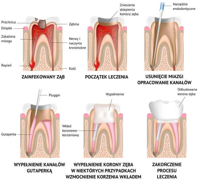 konsekwencje nieleczonej próchnicy schemat