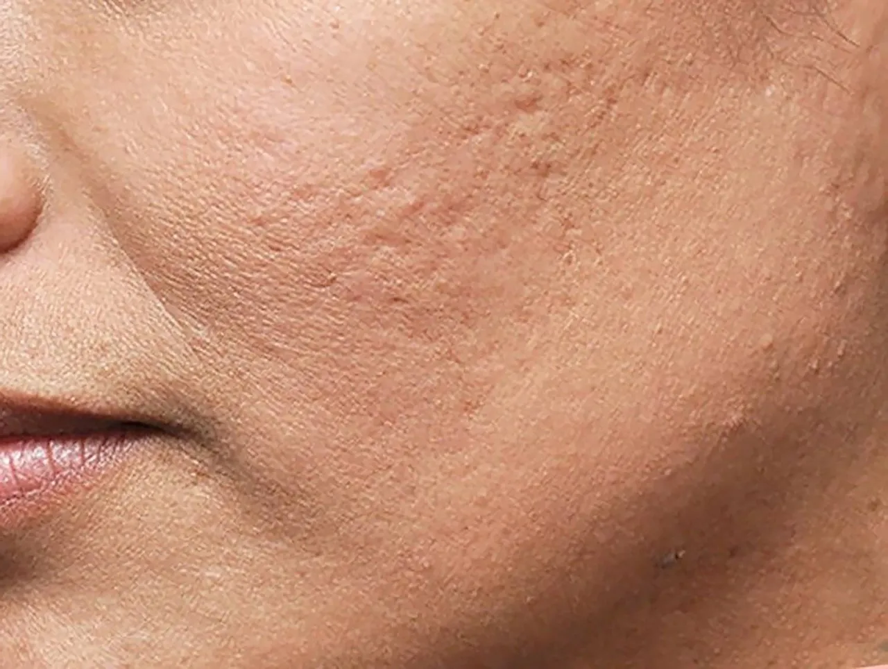 Plasterki hydrokoloidowe na pryszcze