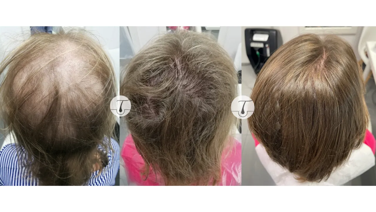 Cykl życia włosa fazy anagen katagen telogen