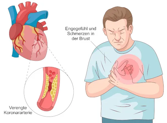 Koronare Herzkrankheit verengte Arterie