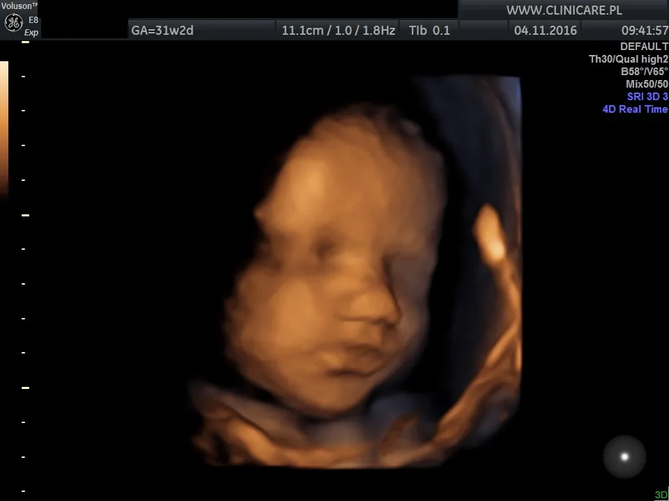 USG ciąży 3 trymestr