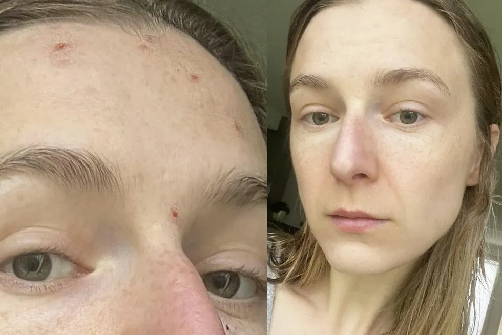 korektor na niedoskonałości przed i po