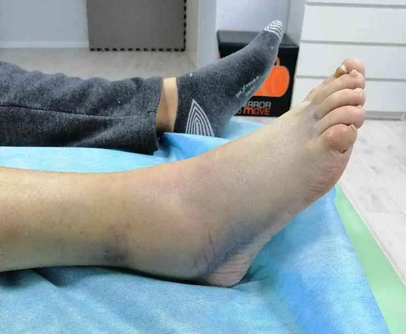 skręcona kostka objawy opuchlizna siniak