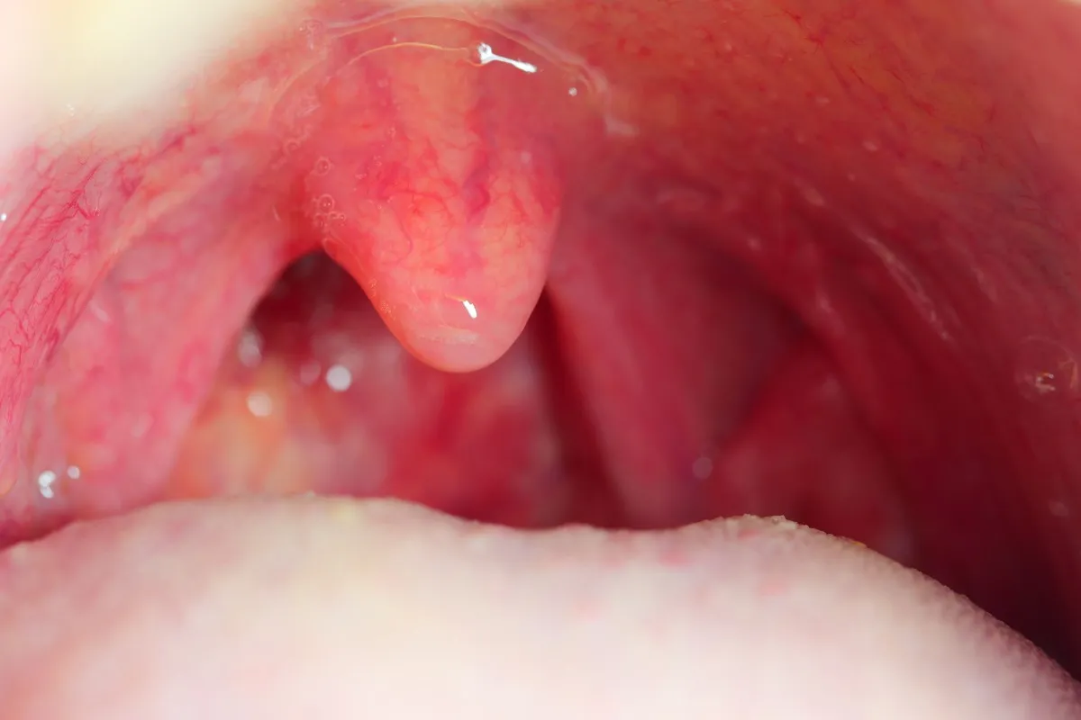 Zdjęcie Sekrety profilaktyki anginy: Zbuduj odporność na cały rok