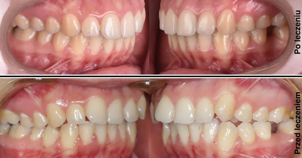 Zdjęcie Czy aparat powiększa usta? Odkryj prawdę o ich wyglądzie