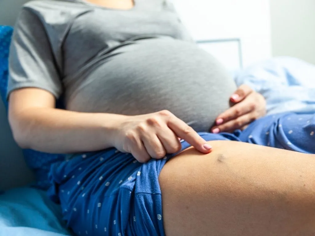 Zdjęcie Czy żylaki w ciąży są groźne? Poznaj ryzyko i powikłania zdrowotne