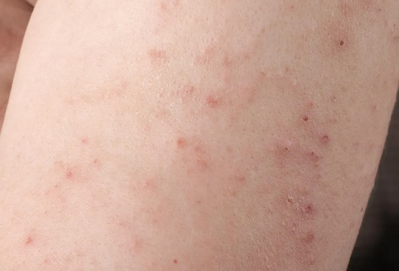 Zdjęcie Najczęstsze objawy atopowego zapalenia skóry - rozpoznaj je u siebie