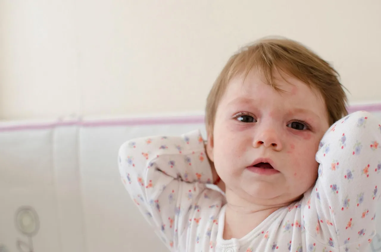 Zdjęcie Co to jest choroba róża? Objawy, przyczyny i skuteczne leczenie