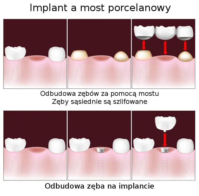 Most protetyczny vs implant wizualne por&oacute;wnanie