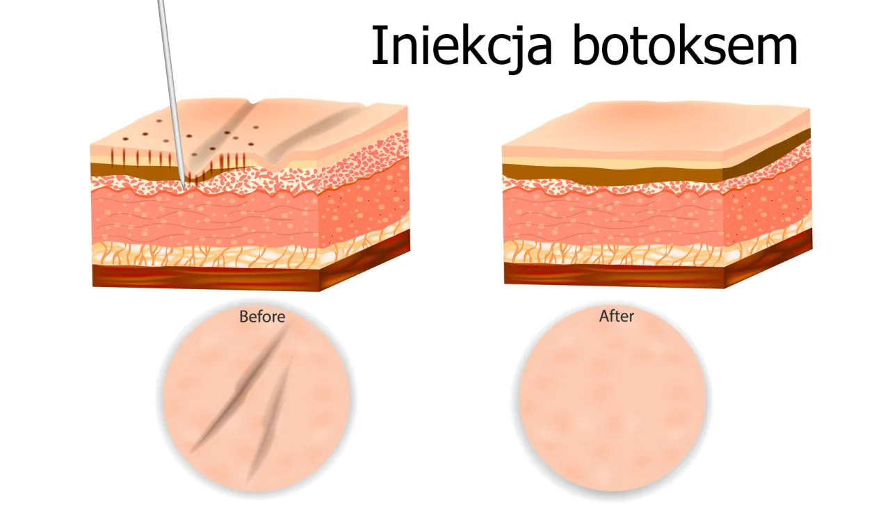 Por&oacute;wnanie toksyny botulinowej Botox i Azzalure