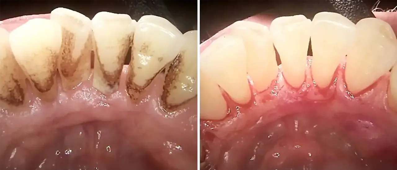 Przed i po leczeniu zapalenia okostnej zęba. Zdjęcie pokazuje zęby z osadem i zdrowe dziąsła po antybiotykoterapii.
