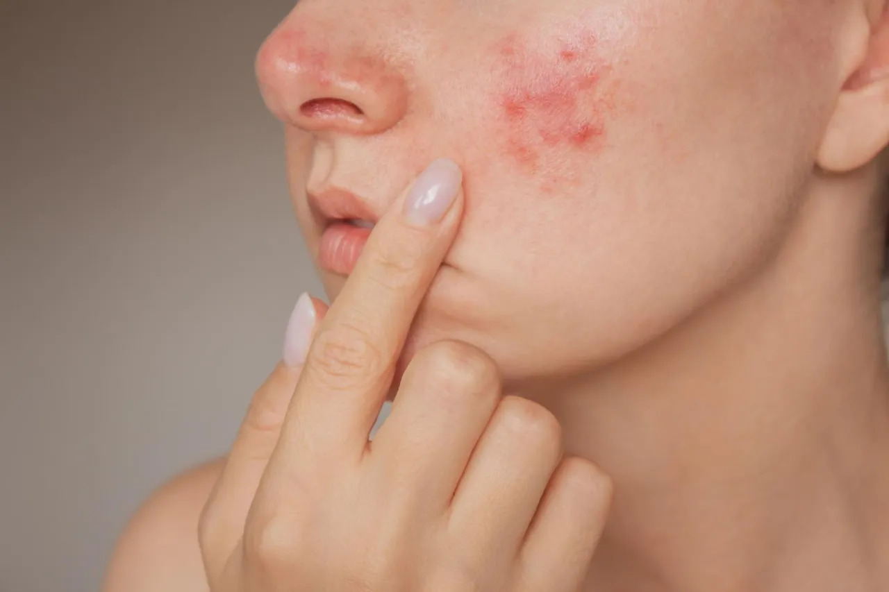 olejek z drzewa herbacianego na pryszcze, domowe sposoby