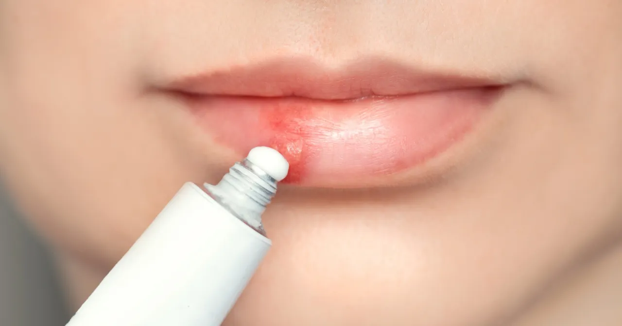 czynniki wywołujące opryszczkę, wyzwalacze opryszczki