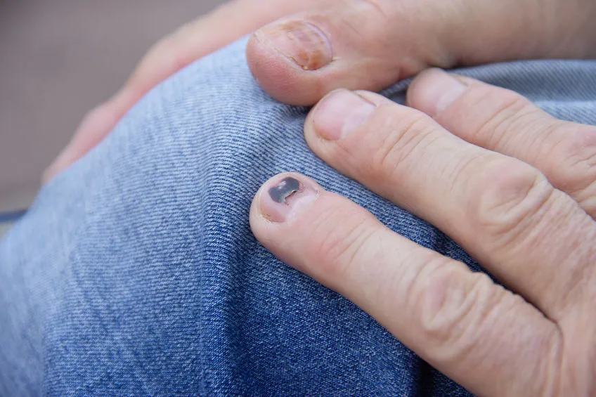 domowe sposoby na krwiak pod paznokciem