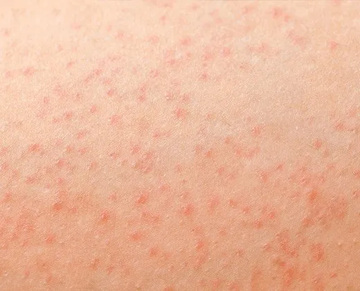 różne typy krostek na skórze, zapalenie mieszków włosowych, rogowacenie okołomieszkowe