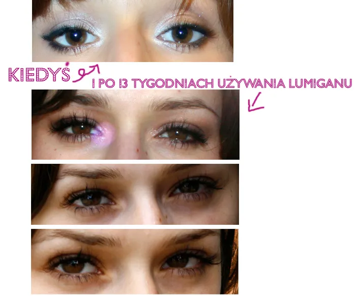 porównanie rzęs przed i po chemioterapii