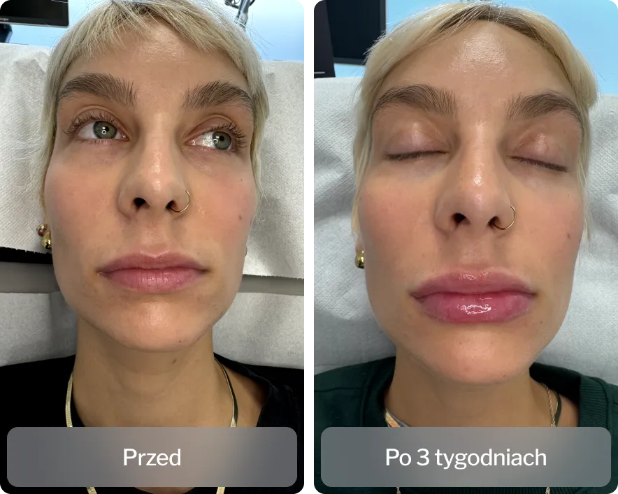 kobieta po zabiegu kwasu hialuronowego delikatna skóra