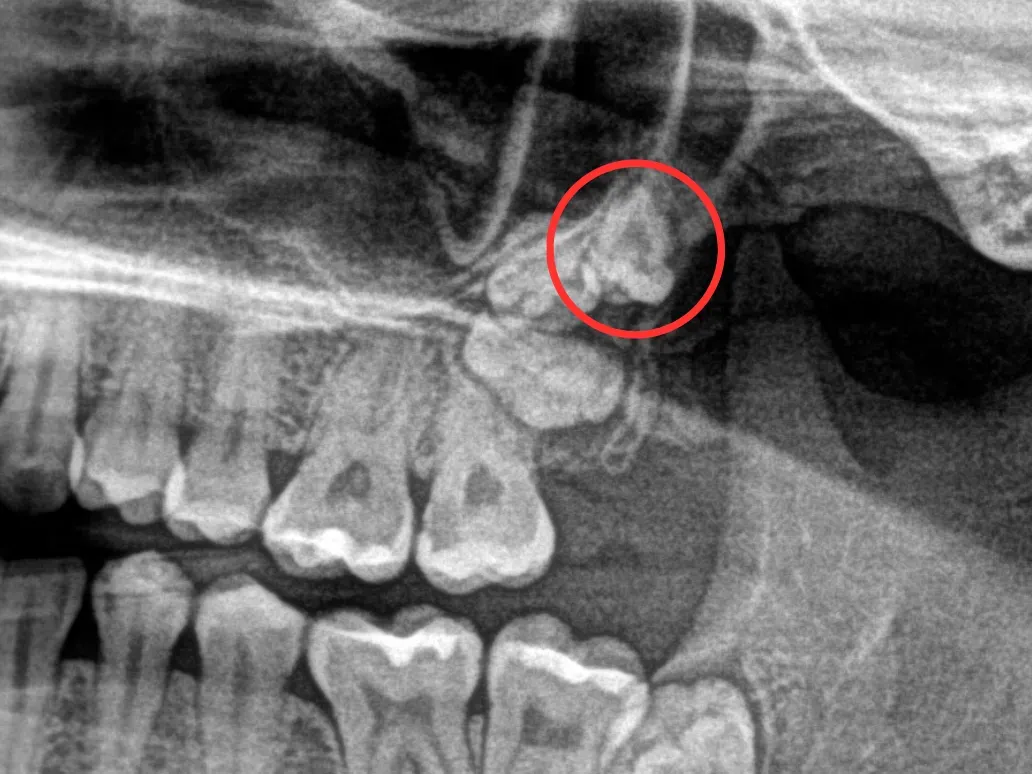zalecenia po wyrwaniu zęba infografika