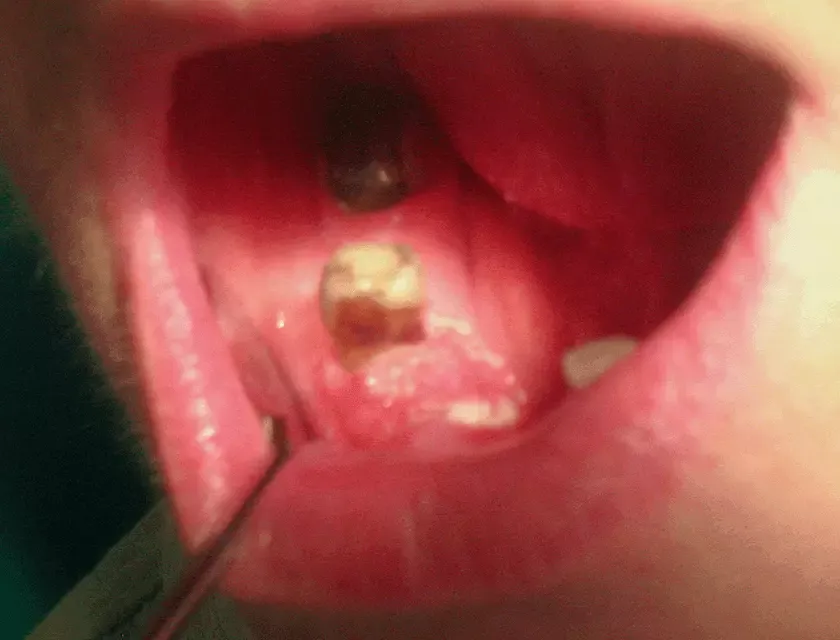 niegojące się owrzodzenie dziąsła rak zdjęcia