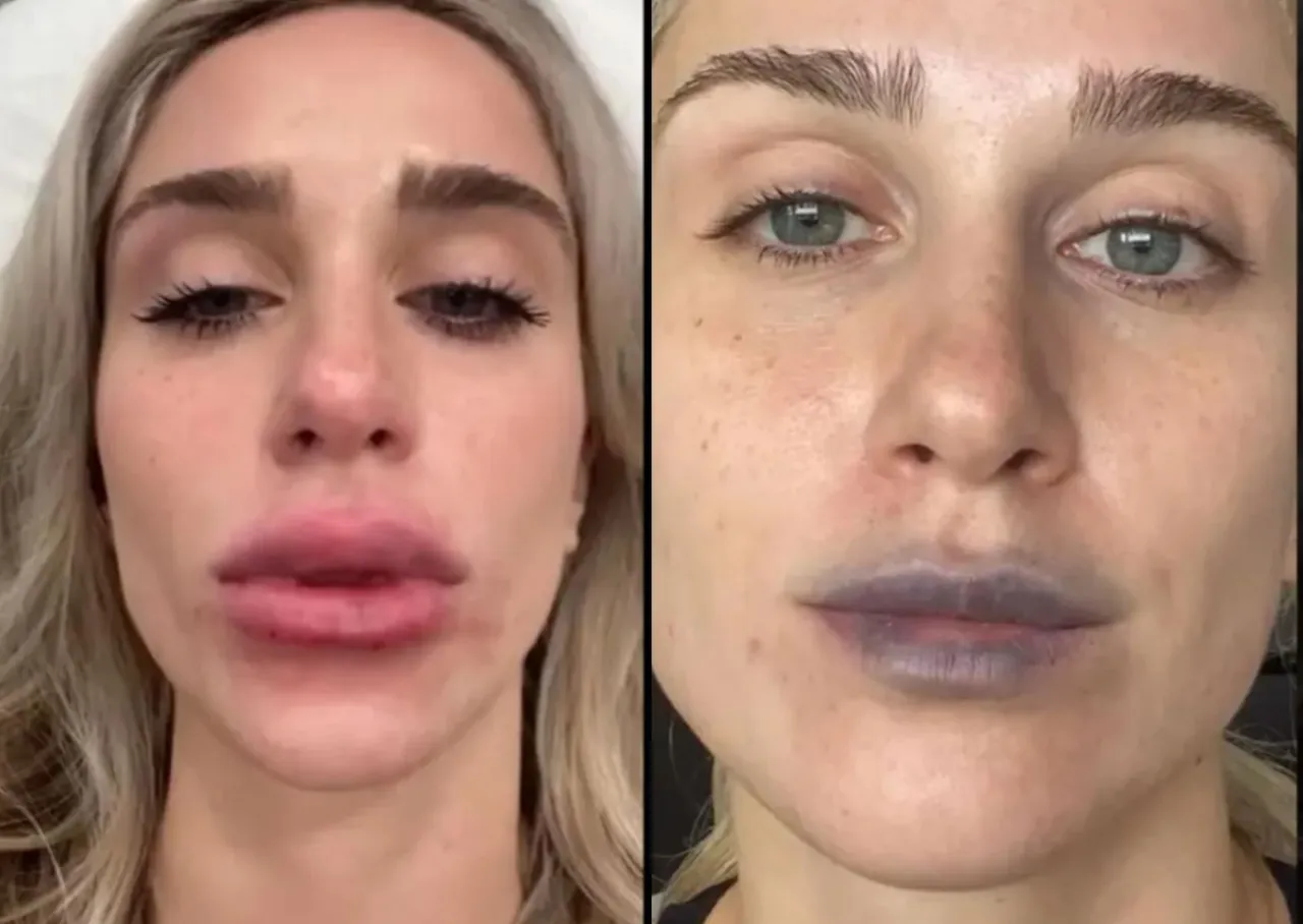 Znieczulenie powiększanie ust