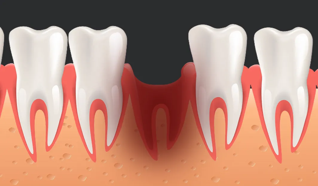 grafika przedstawiająca suchy zębodół lub krwawienie po ekstrakcji zęba