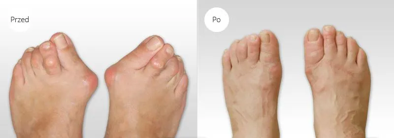 stopa z haluksem przed i po operacji