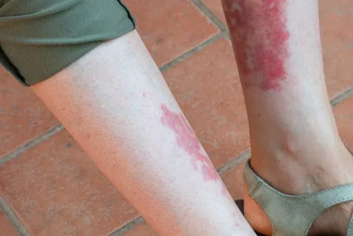 objawy chorób naczyń krwionośnych